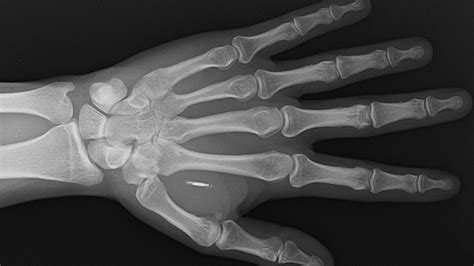 rfid chip hand implant|The microchip implants that let you pay with your .